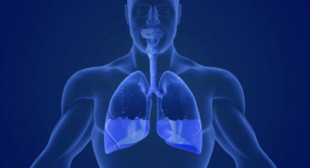 <strong> El derrame pleural es una de las complicaciones del dengue.</strong>   