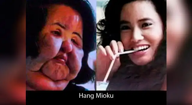 Ex modelo Hang Mioku y su tragedia personal: se inyectó aceite de cocina en el rostro.