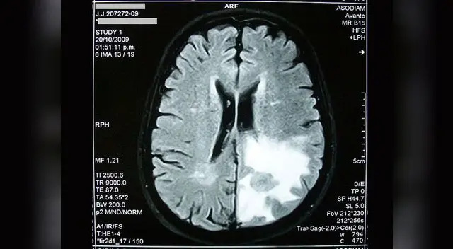 Ejemplo de un cerebro afectado por edema. Ejemplo de un cerebro afectado por edema.