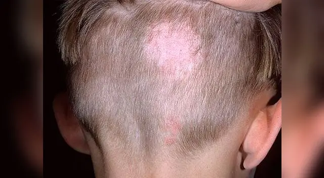 Ataca la tiña de forma natural.