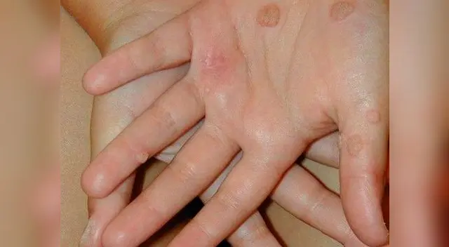 Elimina la verruga al natural. Elimina la verruga al natural.