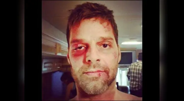 Ricky Martin se muestra golpeado en las redes sociales.