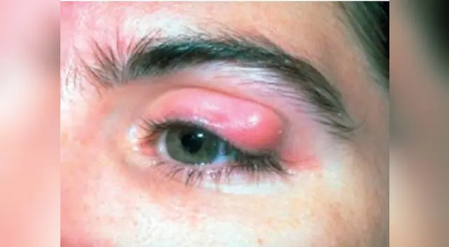 Remedios útiles para el orzuelo.