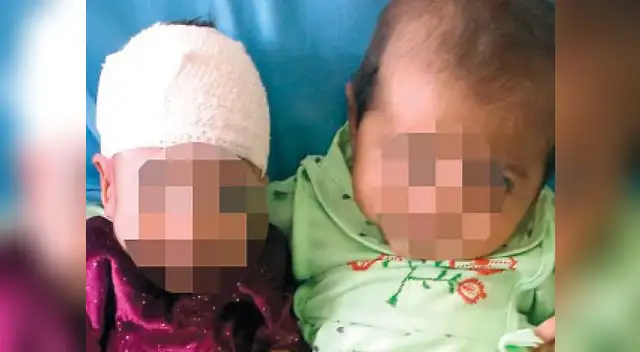 Operan con éxito a bebé que nació con 2 cabezas.