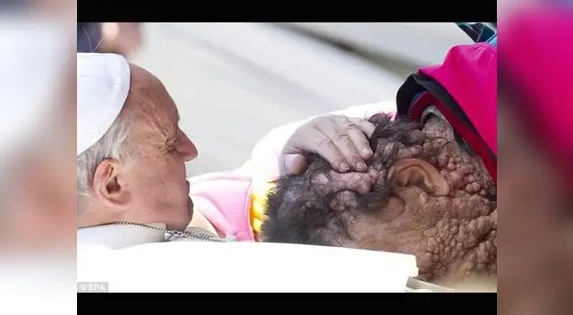 Papa Francisco abraza a hombre con enfermedad en la piel Papa Francisco abraza a hombre con enfermedad en la piel
