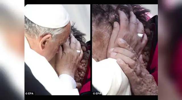 Papa Francisco abraza a hombre con enfermedad en la piel Papa Francisco abraza a hombre con enfermedad en la piel