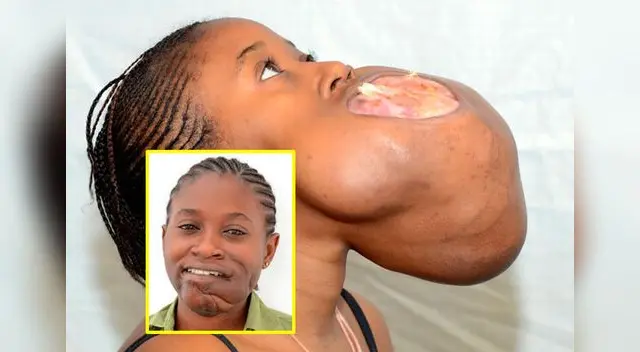 Grace tenía un tumor en la mandíbula. Grace tenía un tumor en la mandíbula.