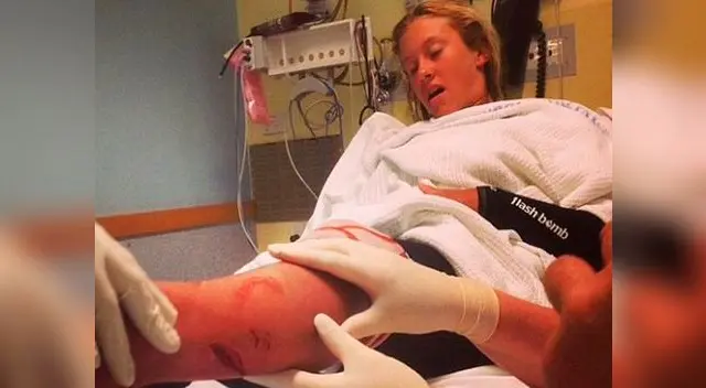 Kirra-Belle Olsson, surfista de 13 años, muestra en Facebook fotos de cómo quedó tras ataque de tiburón Kirra-Belle Olsson, surfista de 13 años, muestra en Facebook fotos de cómo quedó tras ataque de tiburón