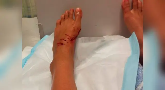 Kirra-Belle Olsson, surfista de 13 años, muestra en Facebook fotos de cómo quedó tras ataque de tiburón Kirra-Belle Olsson, surfista de 13 años, muestra en Facebook fotos de cómo quedó tras ataque de tiburón