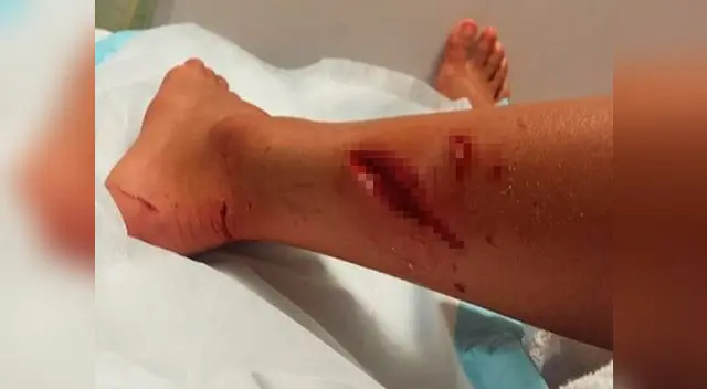 Kirra-Belle Olsson, surfista de 13 años, muestra en Facebook fotos de cómo quedó tras ataque de tiburón Kirra-Belle Olsson, surfista de 13 años, muestra en Facebook fotos de cómo quedó tras ataque de tiburón