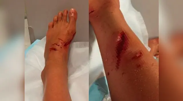 Kirra-Belle Olsson, surfista de 13 años, muestra en Facebook fotos de cómo quedó tras ataque de tiburón Kirra-Belle Olsson, surfista de 13 años, muestra en Facebook fotos de cómo quedó tras ataque de tiburón
