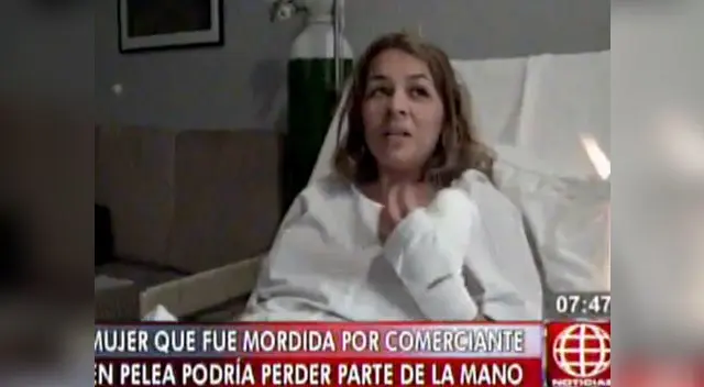 Mujer podría perder por completo el dedo pulgar derecho.