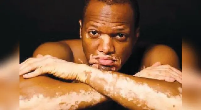 El tratamiento dependerá de la extensión de las manchas. El tratamiento dependerá de la extensión de las manchas.