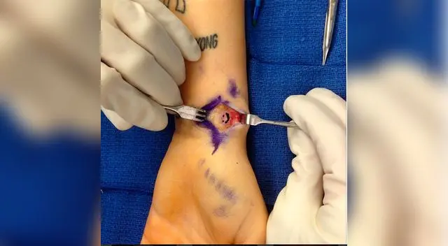 Miley Cyrus tiene una profunda herida. Miley Cyrus tiene una profunda herida.