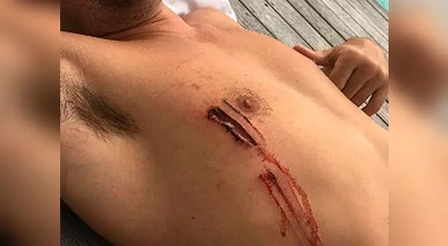 Esa es la herida del ataque de tiburón en un arrecife.