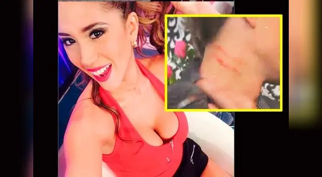 Ignacio Baladán apareció con hematomas cuando estuvo con Melissa Paredes. 