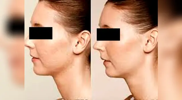 Elimina el acné fácil y rápidamente al natural