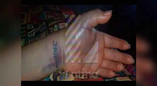 Quedó con la muñeca fracturada. Quedó con la muñeca fracturada.