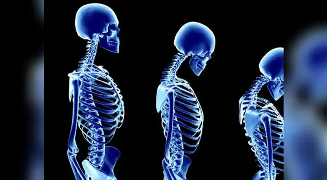 La osteoporosis dinamita nuestros huesos.