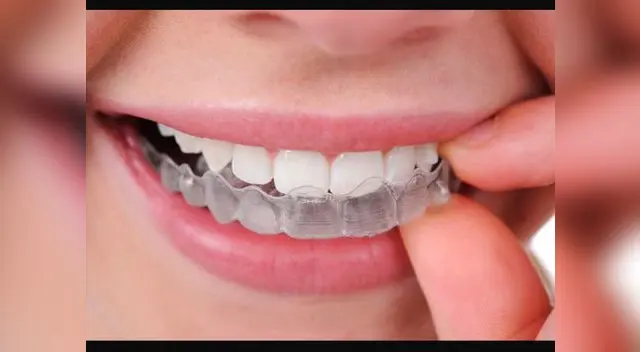 Los protectores dentales ayudan a evitar el desgaste de los dientes 