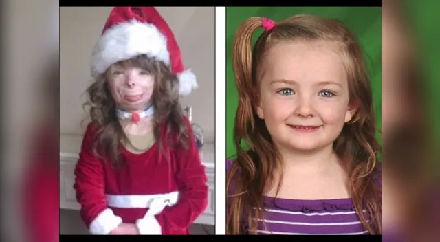 La menor ha sido sometida a 50 cirugías debido al terrible incendio. La menor ha sido sometida a 50 cirugías debido al terrible incendio.