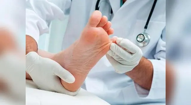 La micosis se puede prevenir y curar.