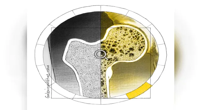 El hueso se vuelve más poroso y aumenta el tamaño de cavidades.