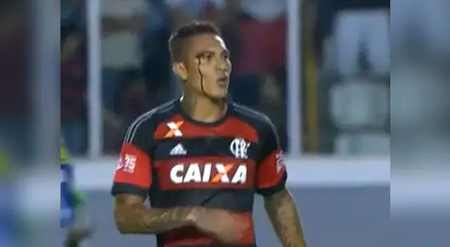 Paolo Guerrero y su corte en la cara. Paolo Guerrero y su corte en la cara.