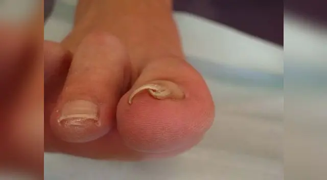 También pueden producir callosidades y uñeros.