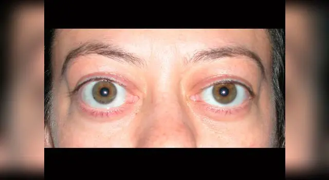 Un síntoma del hipertiroidismo es ojos hinchados