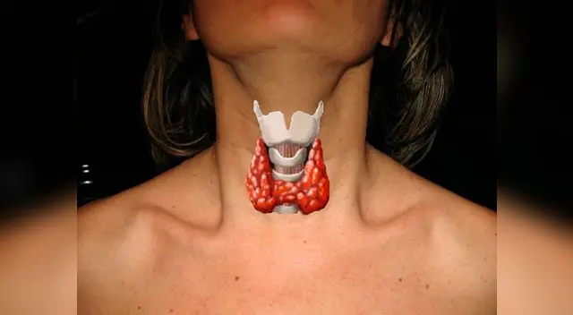 Se produce a causa del exceso o escasez  de producción de las hormonas tiroides