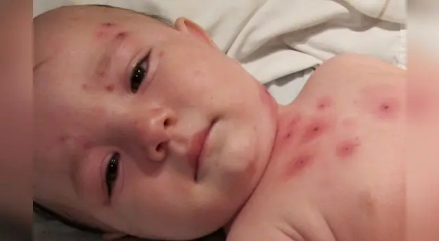 Niños  con cáncer, VIH o desnutrición puede morir de una varicela