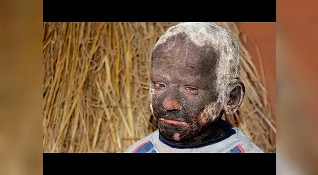 Ramesh Darji tiene una esperanza de mejor calidad de vida gracias a un tratamiento médico