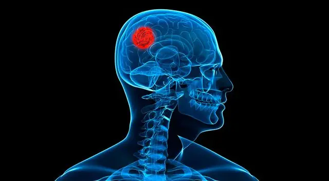Alerta a tumores cerebrales