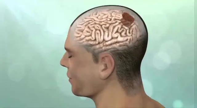 Sintomas de tumores cerebrales aparecen de manera abrupta