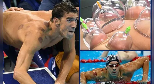 Phelps no es el único deportista que realiza esta terapia