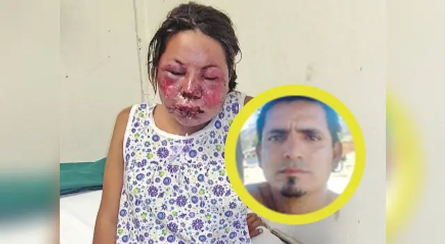 Joven madre continúa internada en hospital limeño Joven madre continúa internada en hospital limeño