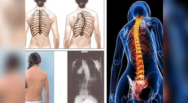 Conoce los signos de alerta de la escoliosis