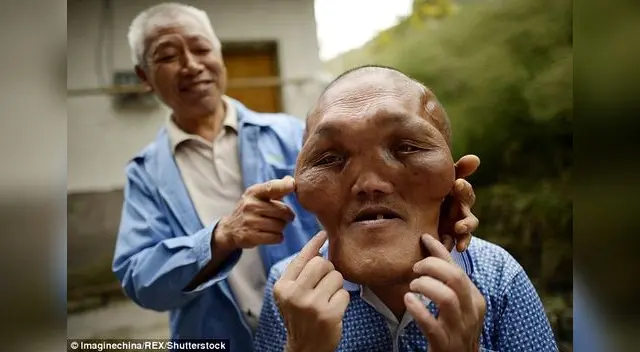 El ciudadano chino sufre de 'hiperplasia facial'
