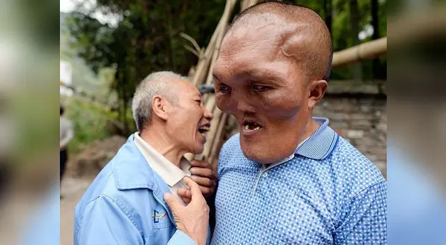 El ciudadano chino sufre de 'hiperplasia facial'