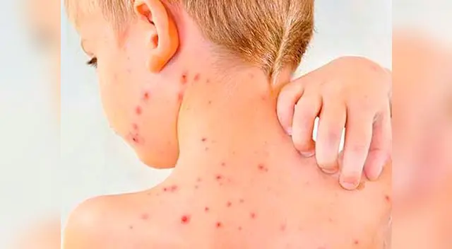 Varicela en niños.