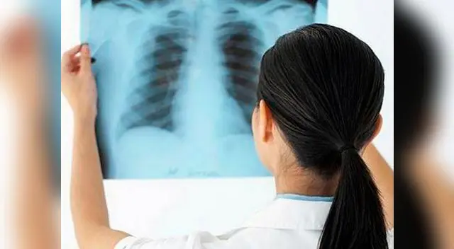 Conoce de qué se trata la fibrosis pulmonar. Conoce de qué se trata la fibrosis pulmonar.