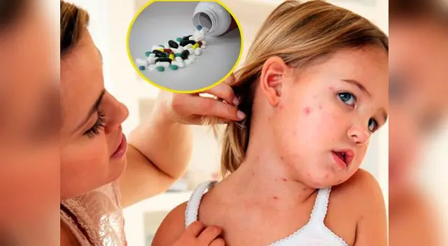 No empeores la varicela de tu hijo. No empeores la varicela de tu hijo.