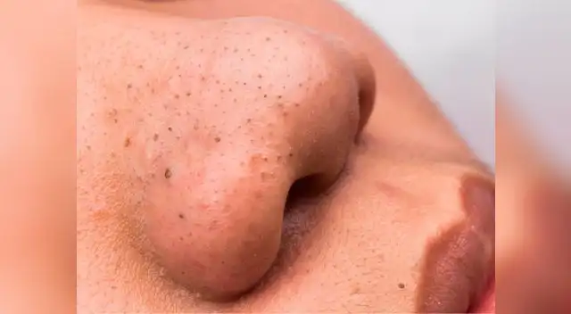 A nadie le gusta tener granos ni espinillas por eso deja de hacer estos habitos