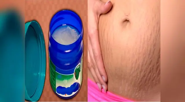 Elimina las estrías con este famoso ungüento. Elimina las estrías con este famoso ungüento.