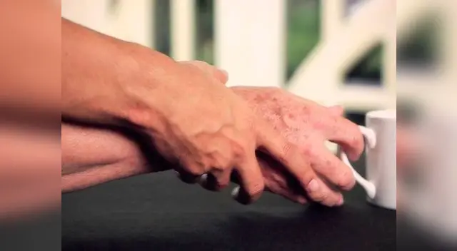 La enfermedad de Parkinson aparece con frecuencia en los adultos mayores, sobre todo en los hombres La enfermedad de Parkinson aparece con frecuencia en los adultos mayores, sobre todo en los hombres