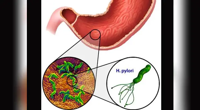 Conoce los síntomas de esta bacteria. Conoce los síntomas de esta bacteria.