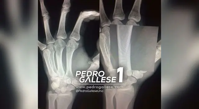 Esta es la radiografía que presentó Pedro Gallese para señalar la gravedad de su lesión.