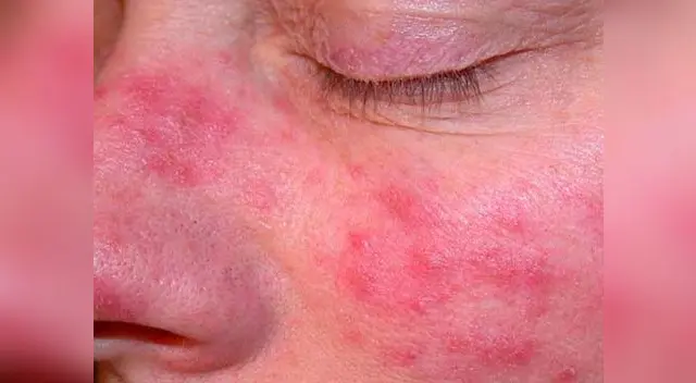 Según el Ministerio de Salud, en Lima, el cáncer de piel ocupa el cuarto lugar entre los cánceres más frecuentes Según el Ministerio de Salud, en Lima, el cáncer de piel ocupa el cuarto lugar entre los cánceres más frecuentes