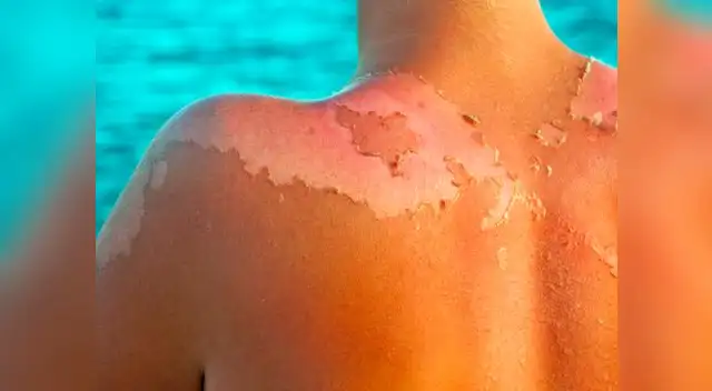 El cáncer de piel aparece generalmente en la etapa adulta por la exposición al sol